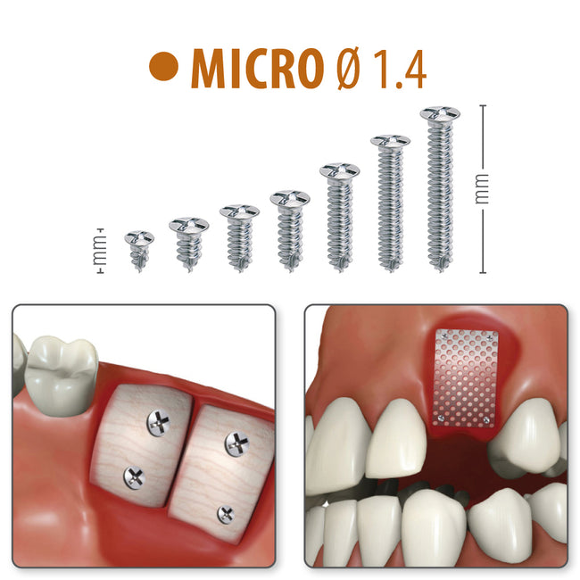 MICRO Ø1.4 - Titanium Screws